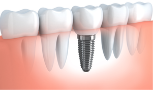 Dental Implants - El Paso, TX - Pershing Dental Care