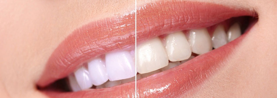 Teeth Whitening in El Paso, TX - If you are considering teeth whitening as a way to remove years of surface and deep stains, you should also understand what to expect after Teeth Whitening.