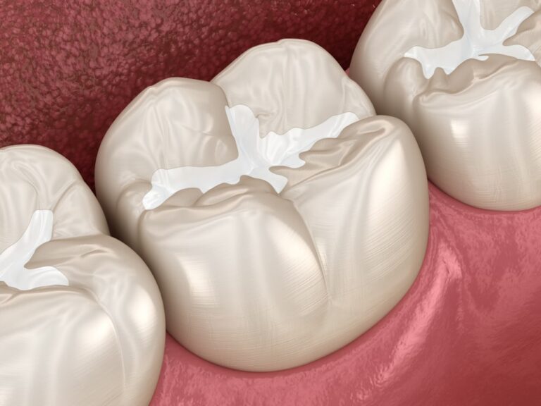 Dental Sealants The Unsung Heroes in Cavity Prevention PERSHING