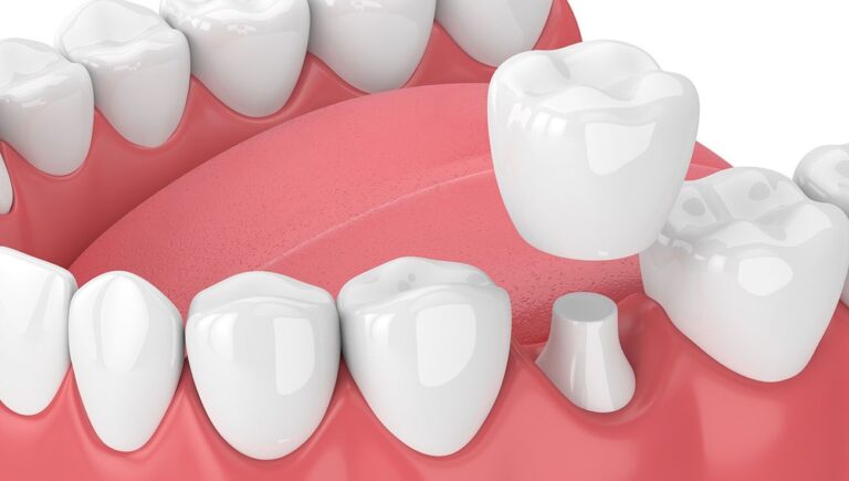 Post-Op Care for Crowns and Bridges