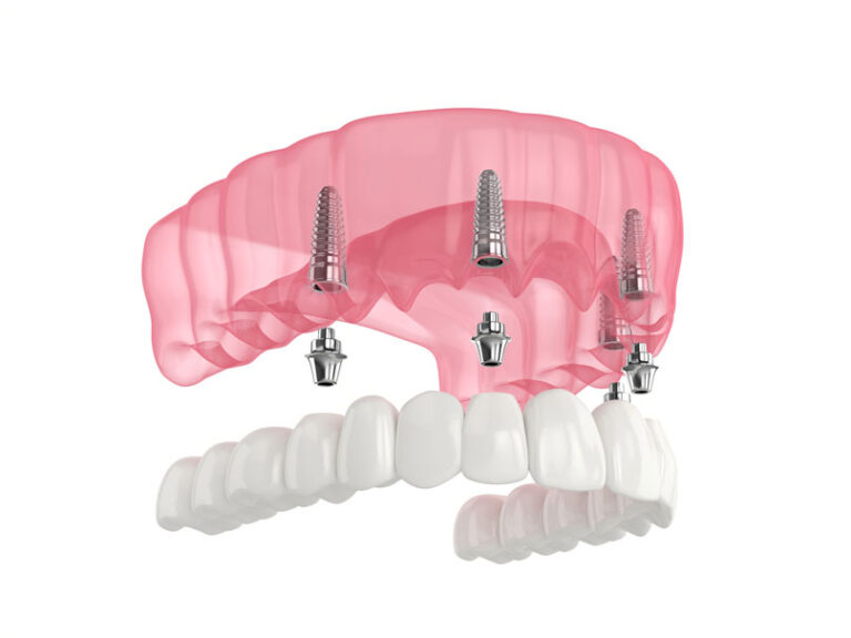 Common Myths About Dentures Debunked