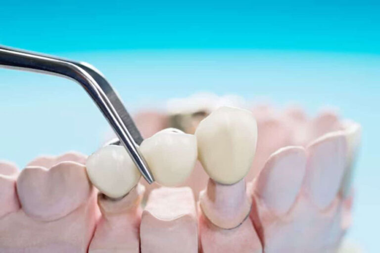 5 Signs You Might Need a Dental Crown or Bridge