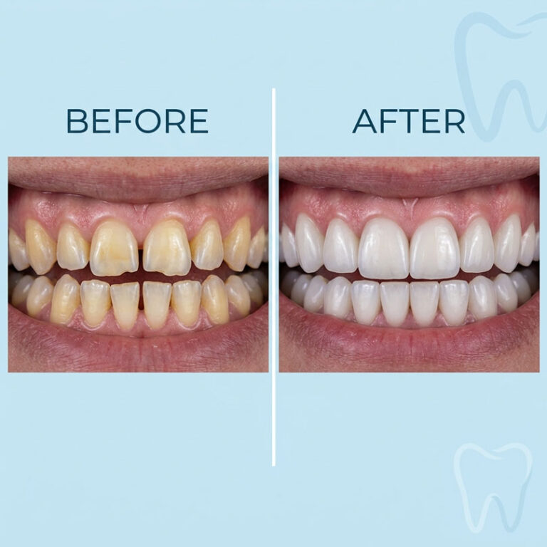 How Dental Veneers Can Transform Your Smile in Just Two Visits
